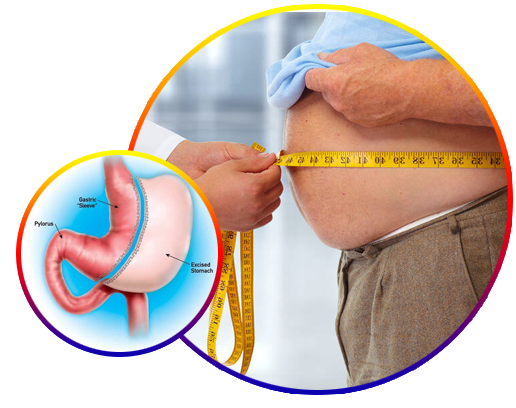 Bariatric Surgery doctor-in-hyderabad 