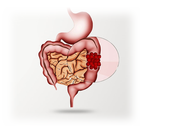 Colorectal Surgery