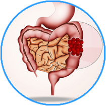 colorectal-surgery