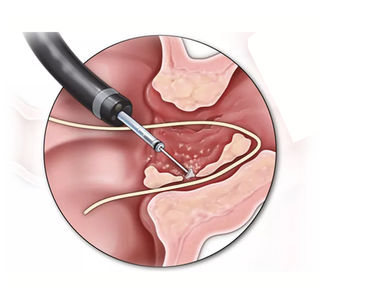 Fistula Surgery