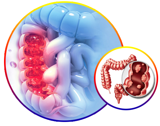 GI Oncology-in-hyderabad 